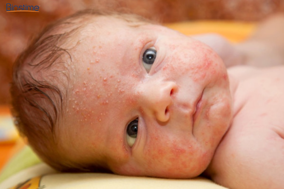Tình trạng trẻ sơ sinh nổi mụn trắng hạt kê thường gặp ở giai đoạn 0 - 2 tháng tuổi