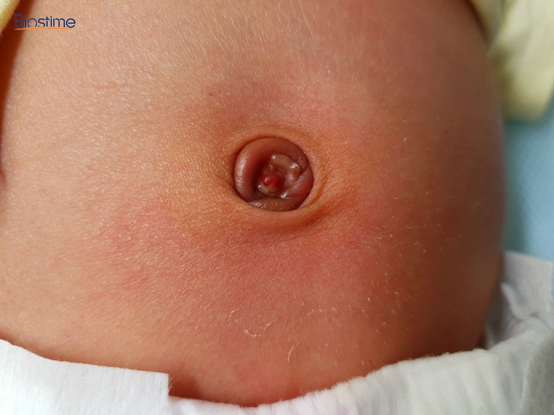 Hình ảnh rốn trẻ sơ sinh bình thường và khi bị nhiễm trùng