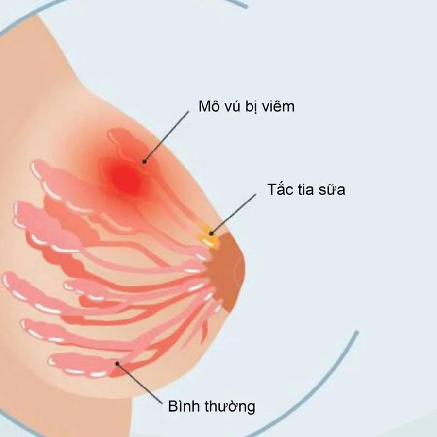 viêm tuyến sữa