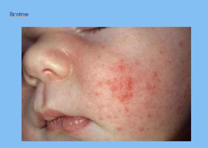 Chi tiết các bệnh da liễu ở trẻ sơ sinh và cách điều trị 7 bệnh da liễu ở trẻ sơ sinh