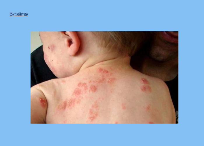 Chi tiết các bệnh da liễu ở trẻ sơ sinh và cách điều trị 8 bệnh da liễu ở trẻ sơ sinh