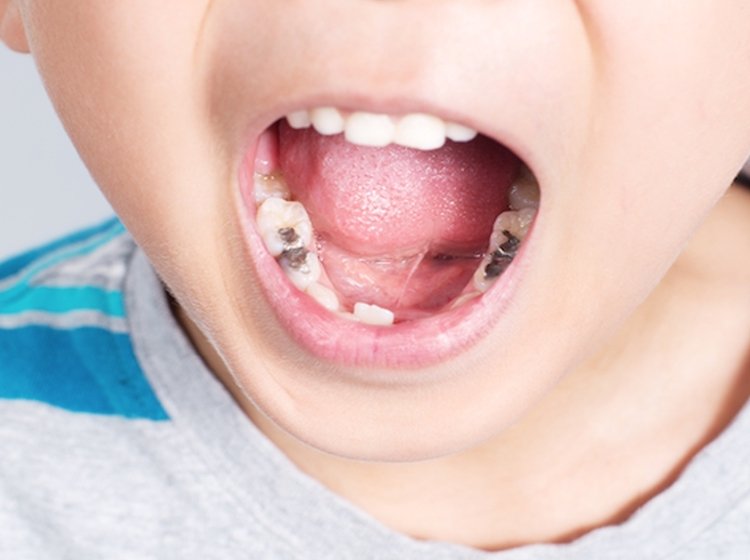 Trẻ bị sâu răng hàm: Nguyên nhân và cách điều trị hiệu quả 6 Sâu răng hàm ở trẻ phổ biến trong giai đoạn mọc răng sữa, cần phát hiện sớm và điều trị kịp thời