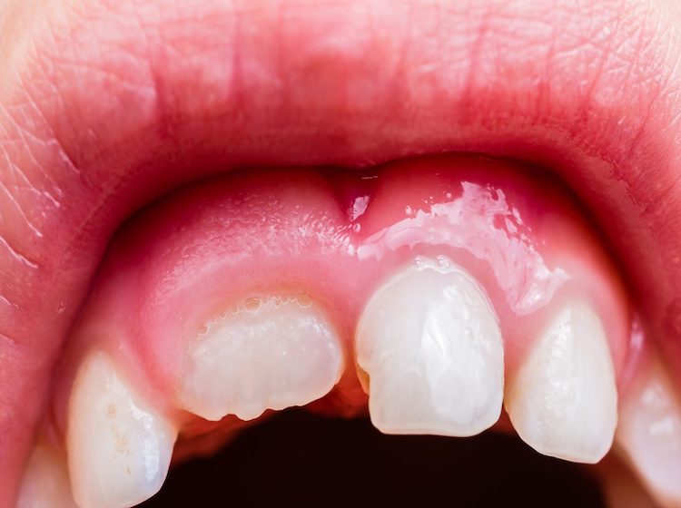 Trẻ bị sâu răng hàm: Nguyên nhân và cách điều trị hiệu quả 7 Viêm nướu xảy ra khi vùng nướu xung quanh răng sâu bị sưng đỏ