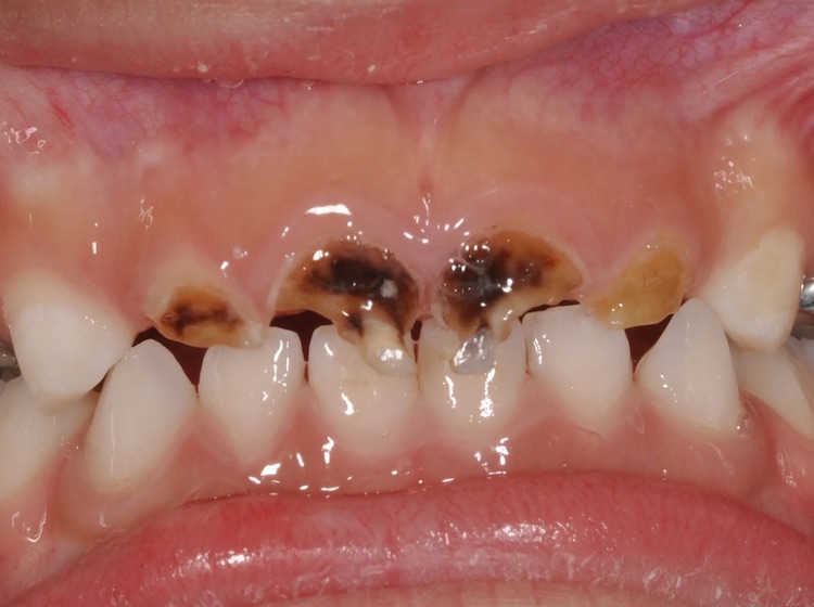 Trẻ bị sâu răng hàm: Nguyên nhân và cách điều trị hiệu quả 8 Sâu răng hàm ảnh hưởng đến thẩm mỹ